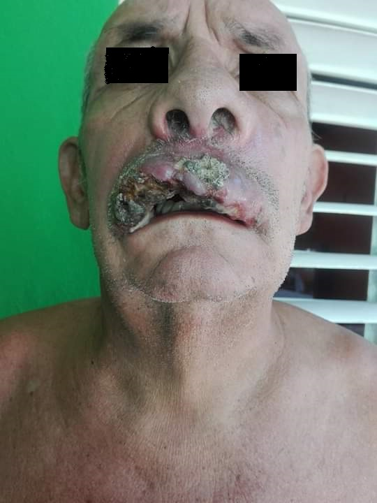 Necrosis labio superior