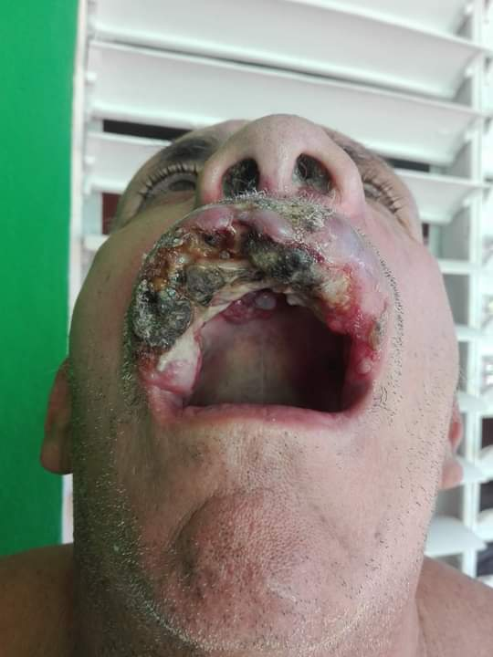 Extensión de la necrosis