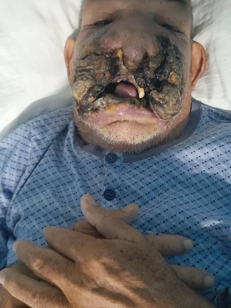 Etapa final de la enfermedad