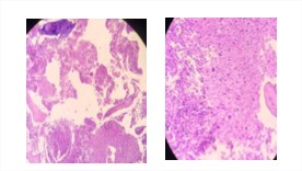 Infiltración tumoral de LNH en médula ósea